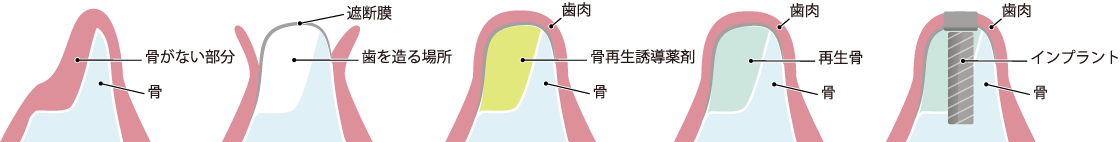 しっかりした土台を創る 骨造成　GBR