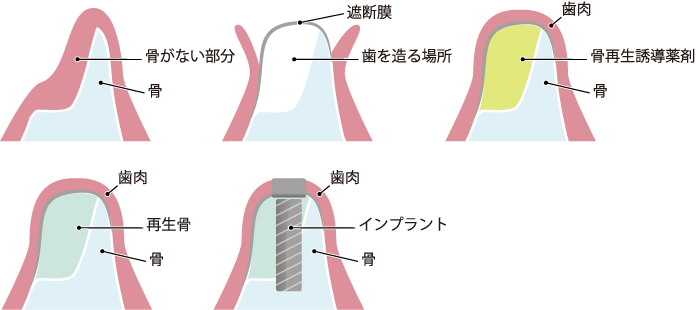 しっかりした土台を創る 骨造成　GBR