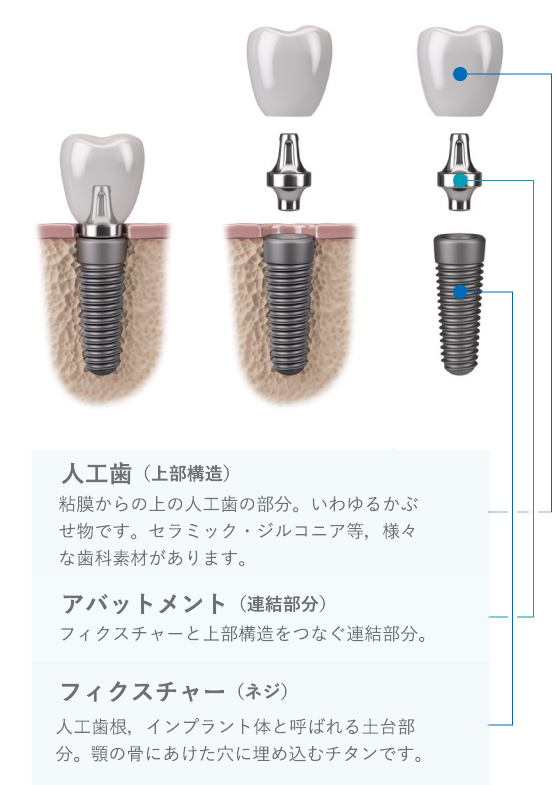 インプラントの構造を知る