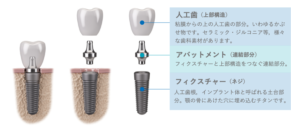 インプラントの構造を知る