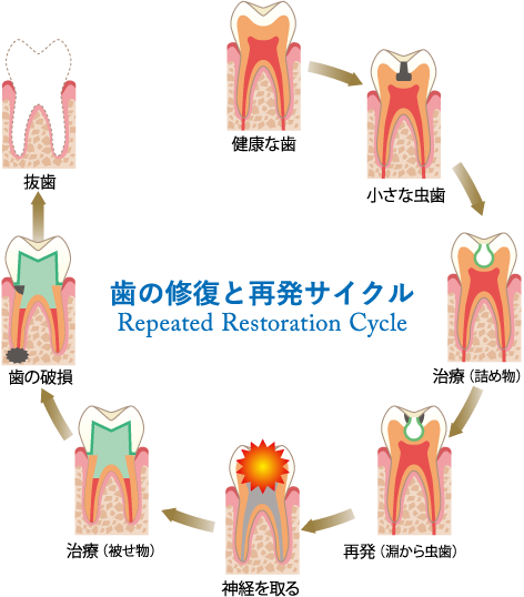 歯の修復と再発サイクル Repeated Restoration Cycle