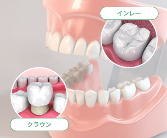 歯を補強する、詰め物・被せの良さを提案する