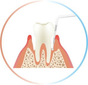 口腔清掃 スケーリング