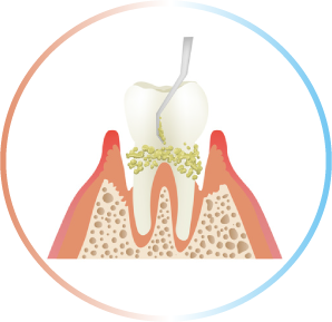 歯周病治療 ルートプレーニング